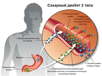 сахарный диабет 2 типа