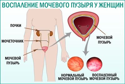 «Ципрофлоксацин» – препарат для лечения цистита