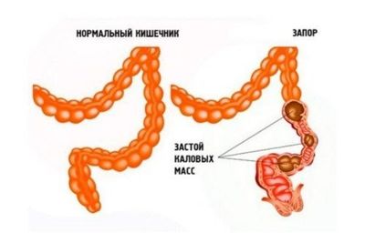 Запор кишечника. Запор кишечника.