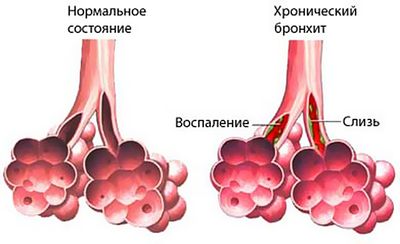 воспаление бронхов