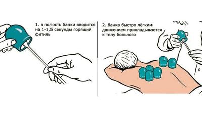 Как правильно ставить банки