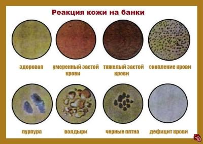 реакция кожи на банке