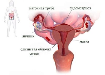 Боли при месячных
