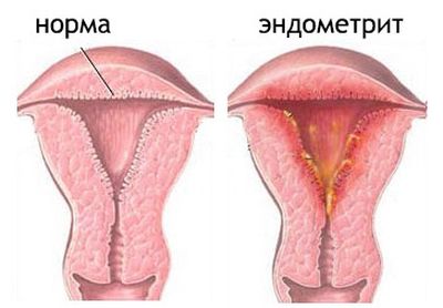 Эндометрит