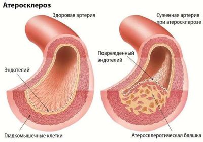 причиной боли в пояснице может быть атеросклероз сосудов