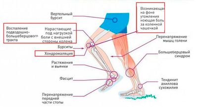 Причины боли в коленях после бега: норма или симптом серьезного заболевания