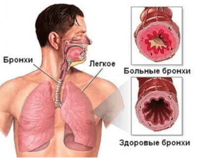 Бронхит
