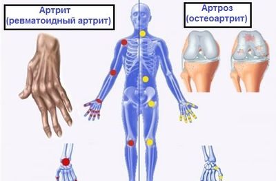 Симптомы артрита