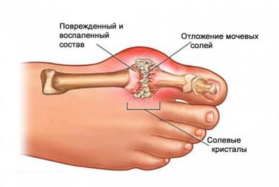 Тофусы при подагре