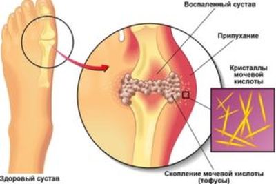 Накопление мочевой кислоты
