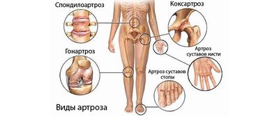 Виды артрозов суставов