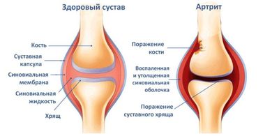 Артрит суставов