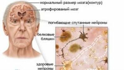 Смерть нейронов головного мозга