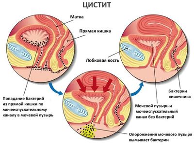 цистит при беременности