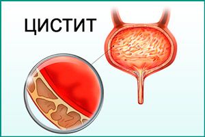 Цистит при беременности