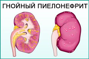 Пиелонефрит