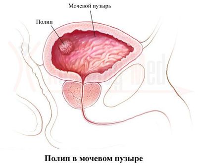 полипы на стенках мочевого пузыря