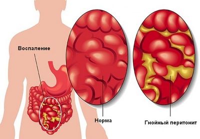 перетонит