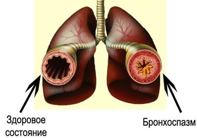 бронхоспазм рисунок
