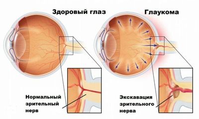 глаукома причины развития