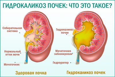 что такое гидрокаликоз