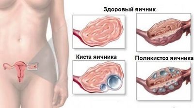 киста яичника