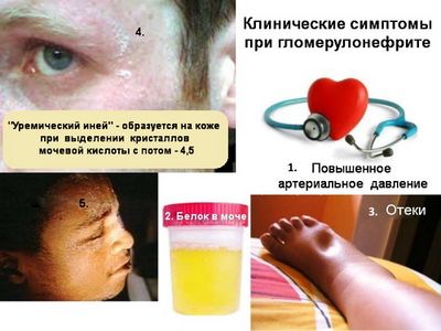 симптомы гломероунефрита