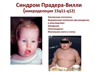 синдром Прадера-Вилли