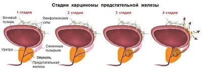 стадии рака простаты
