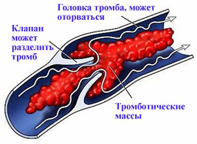 тромбообразования в сосудах