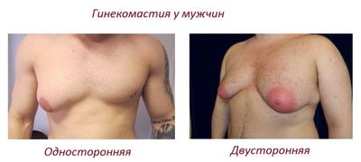 гинекомастия у мужчин виды