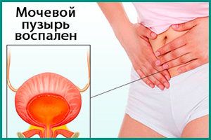 Что представляет собой хроническое воспаление мочевого пузыря