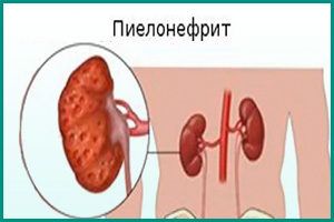 Заболевание почек