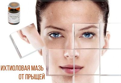 Как использовать ихтиоловую мазь при угрях, прыщах