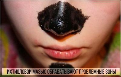 Как использовать ихтиоловую мазь от прыщей