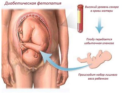 диабетическая фетопатия