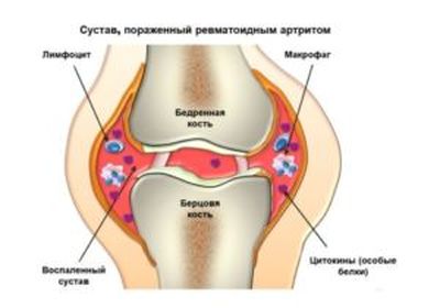 Ревматизм коленного сустава