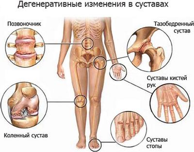 Формы болезни Бехтерева