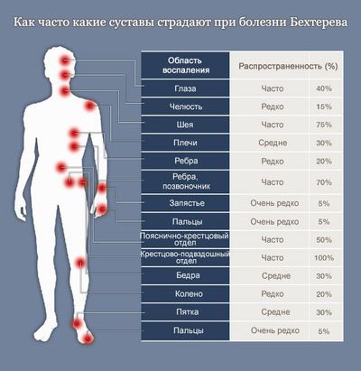 Виды локализации спондилита