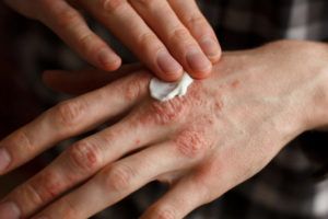 Препарат наносят на область воспаления