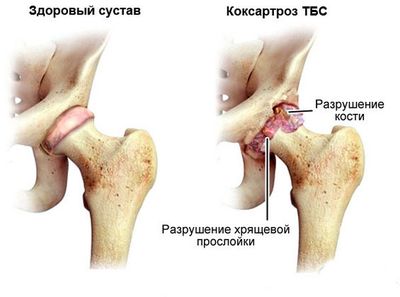 Коксартроз тазобедренного сустава: симптомы