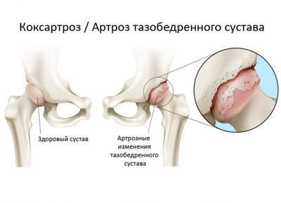 Важно отличить коксартроз от других патологий, связанных с суставами