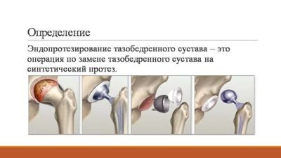 При коксартрозе третьей степени показано эндопротезирование