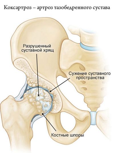 При коксартрозе хрящи становятся тонкими из-за того, что они повреждают друг друга при движении