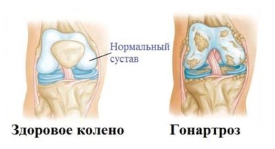 Гонартроз