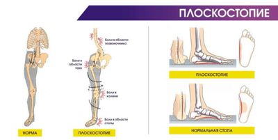 Плоскостопие может стать причиной развития коксартроза