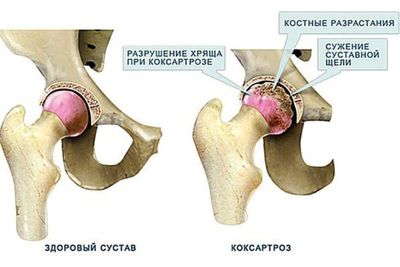 Выделяют несколько степеней коксартроза
