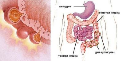 Дивертикулез