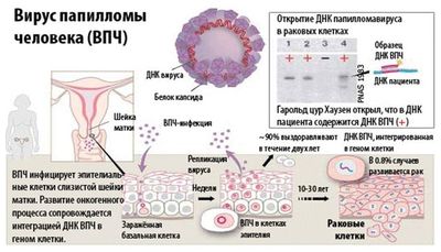 ВПЧ и рак