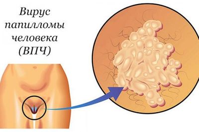 Как выглядит ВПЧ